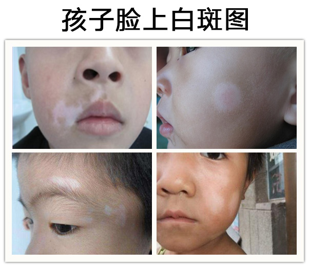 孩子脸上出现白斑可能是什么皮肤病