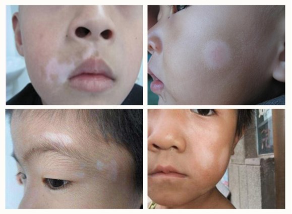 儿童脸上白癜风症状有哪些表现？