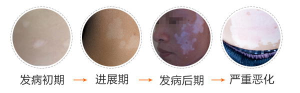 白癜风早期症状照片？