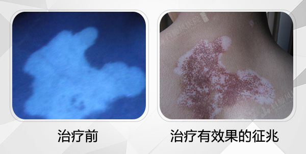 小儿白癜风如何预防复发呢？