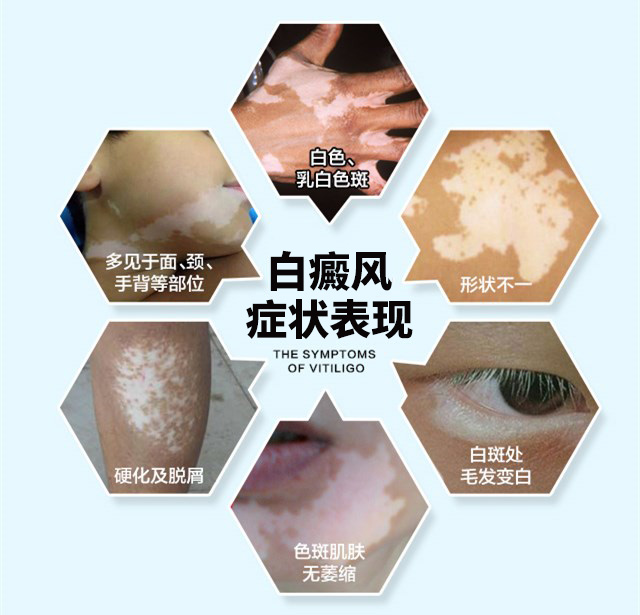 孩子得了白癜风我们该怎么办？