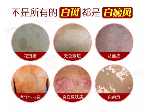 孩子身上出现白斑是什么