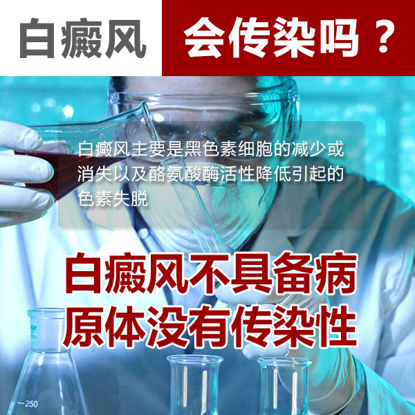 白癜风传染吗?