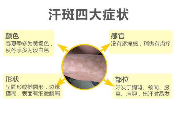 如何区分白癜风和汗斑？