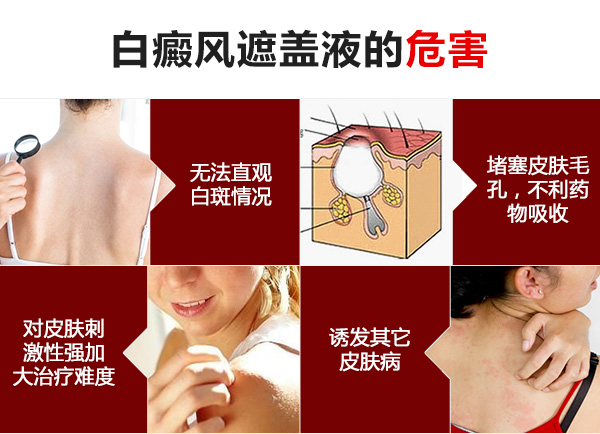 白癜风遮盖液的危害