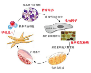 如何治疗白癜风？