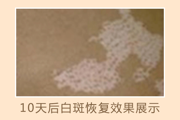 　皮肤上出现白斑会叫白癜风吗？