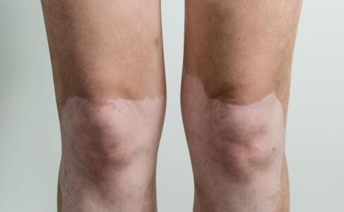 大腿处白癜风治疗需要注意什么