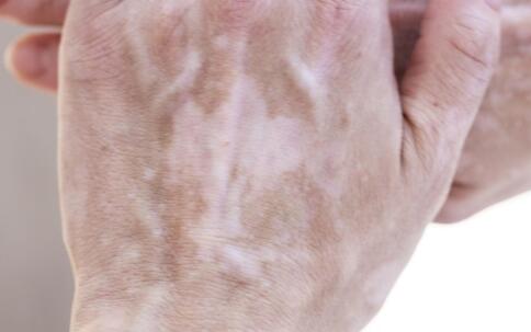 哪些皮肤过敏会引起白癜风？