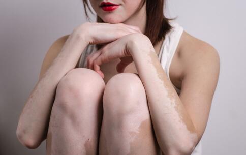 染发对女性头部白斑的伤害你知道有多厉害吗？