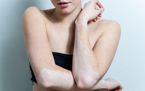 女性身上长白斑是哪些原因导致的