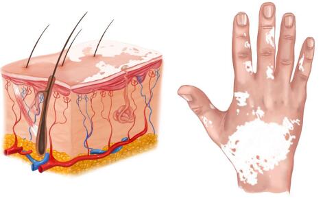 长沙白癜风如何治疗才有效？