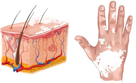 　家长应该如何护理患有白癜风、白斑的孩子呢？