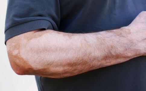 成年人治疗手臂白癜风应该注意什么