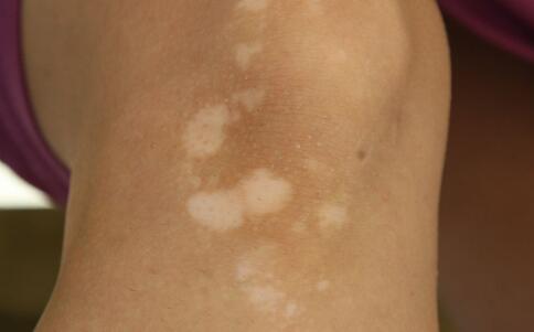 导致腿部长白癜风白斑的病因是什么呢