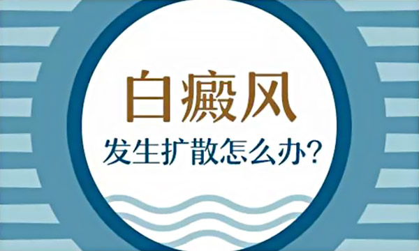 永州白癜风发生扩散怎么办？