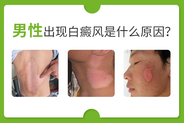 男性患白癜风的原因是什么