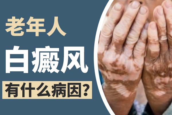 哪些人群容易患发白癜风?